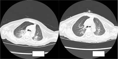 Case Report: A case of spinal muscular atrophy with extensively drug-resistant Acinetobacter baumannii pneumonia treated with nebulization combined with intravenous polymyxin B: experience and a literature review